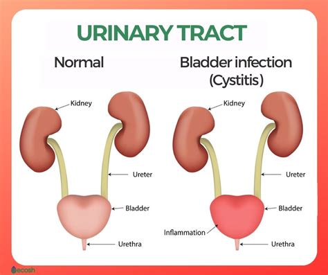 I often get bladder infection, is there a treatment?